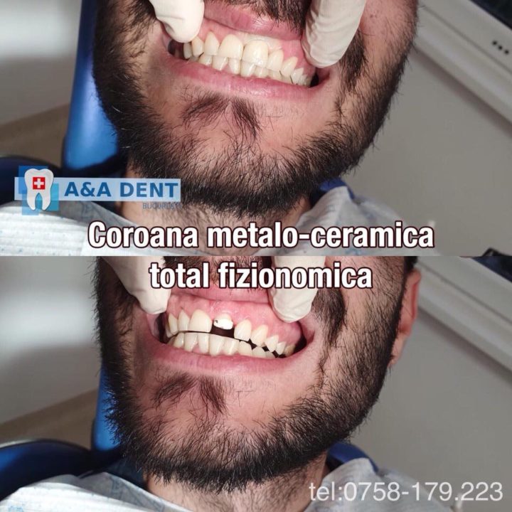 Coroana-metalo-ceramica-total-fizionomica-🏩-CENTRUL-DE-ESTETICA-si-🏥-AA-DENT-720x720