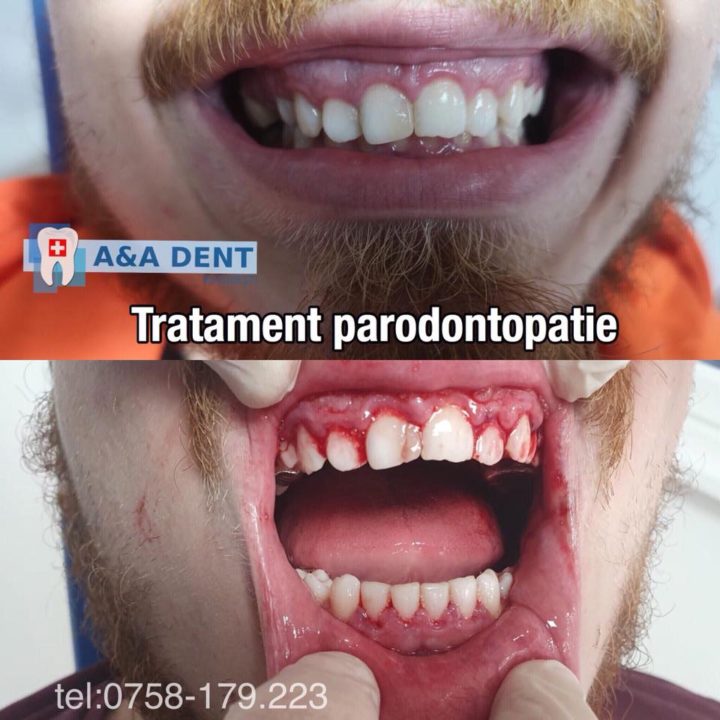 Tratament-parodontopatie-🏩-CENTRUL-DE-ESTETICA-si-🏥-AA-DENT-720x720