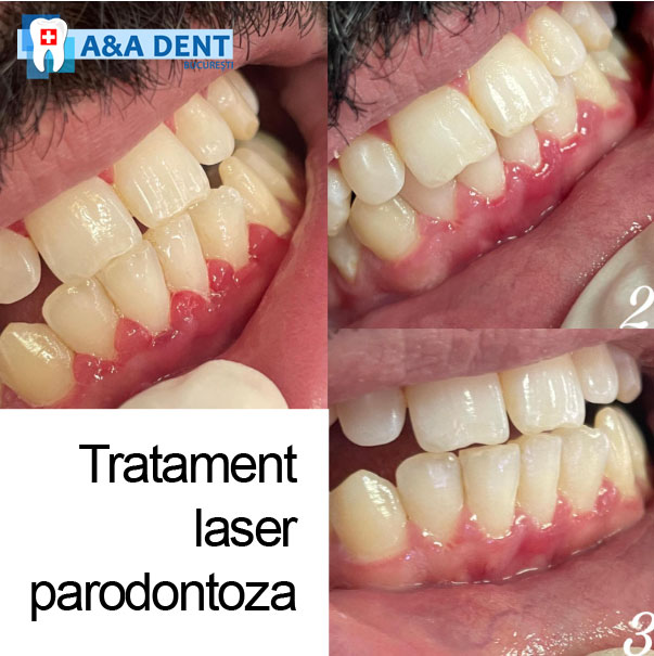 tratament-parodontoza-laser